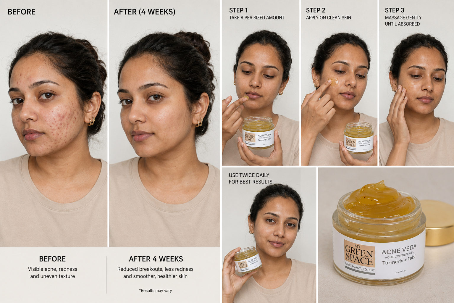 Acne Veda – Acne Control Gel
